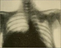 Picture 141 of 147 from The Röntgen rays in medical work (1907), leaf 362