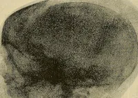 Picture 144 of 147 from The Röntgen rays in medical work (1907), leaf 415
