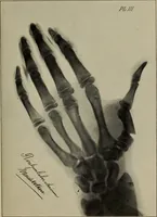An illustration from Röntgentechniek : therapeutische beteekenis der "X" -stralen en der stoomen van hooge fréquentie (1904)