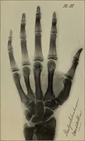 An illustration from Röntgentechniek : therapeutische beteekenis der "X" -stralen en der stoomen van hooge fréquentie (1904)