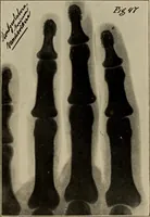 Picture 53 of 72 from Röntgentechniek : therapeutische beteekenis der "X" -stralen en der stoomen van hooge fréquentie (1904), leaf 89