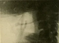 An illustration from The Roentgen rays in medicine and surgery as an aid in diagnosis and as a therapeutic agent : designed for the use of practitioners and students (1901)