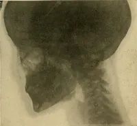 An illustration from The Roentgen rays in medicine and surgery as an aid in diagnosis and as a therapeutic agent : designed for the use of practitioners and students (1901)