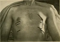 An illustration from The Roentgen rays in medicine and surgery as an aid in diagnosis and as a therapeutic agent : designed for the use of practitioners and students (1901)