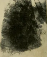 An illustration from The Roentgen rays in medicine and surgery as an aid in diagnosis and as a therapeutic agent : designed for the use of practitioners and students (1901)
