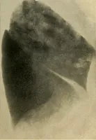 An illustration from The Roentgen rays in medicine and surgery as an aid in diagnosis and as a therapeutic agent : designed for the use of practitioners and students (1901)