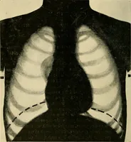 An illustration from The Roentgen rays in medicine and surgery as an aid in diagnosis and as a therapeutic agent : designed for the use of practitioners and students (1901)