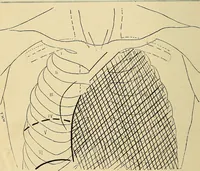 An illustration from The Roentgen rays in medicine and surgery as an aid in diagnosis and as a therapeutic agent : designed for the use of practitioners and students (1901)