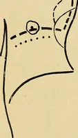 An illustration from The Roentgen rays in medicine and surgery as an aid in diagnosis and as a therapeutic agent : designed for the use of practitioners and students (1901)