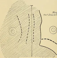 An illustration from The Roentgen rays in medicine and surgery as an aid in diagnosis and as a therapeutic agent : designed for the use of practitioners and students (1901)
