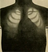 An illustration from The Roentgen rays in medicine and surgery as an aid in diagnosis and as a therapeutic agent : designed for the use of practitioners and students (1901)