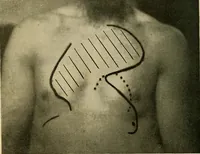 An illustration from The Roentgen rays in medicine and surgery as an aid in diagnosis and as a therapeutic agent : designed for the use of practitioners and students (1901)