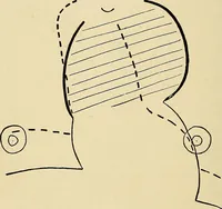 An illustration from The Roentgen rays in medicine and surgery as an aid in diagnosis and as a therapeutic agent : designed for the use of practitioners and students (1901)