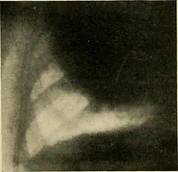 An illustration from The Roentgen rays in medicine and surgery as an aid in diagnosis and as a therapeutic agent : designed for the use of practitioners and students (1901)