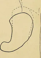 An illustration from The Roentgen rays in medicine and surgery as an aid in diagnosis and as a therapeutic agent : designed for the use of practitioners and students (1901)