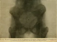 An illustration from The Roentgen rays in medicine and surgery as an aid in diagnosis and as a therapeutic agent : designed for the use of practitioners and students (1901)