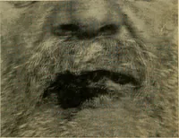 An illustration from The Roentgen rays in medicine and surgery as an aid in diagnosis and as a therapeutic agent : designed for the use of practitioners and students (1901)