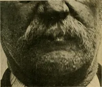 An illustration from The Roentgen rays in medicine and surgery as an aid in diagnosis and as a therapeutic agent : designed for the use of practitioners and students (1901)