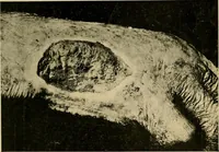 An illustration from The Roentgen rays in medicine and surgery as an aid in diagnosis and as a therapeutic agent : designed for the use of practitioners and students (1901)
