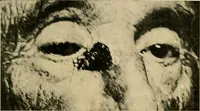 An illustration from The Roentgen rays in medicine and surgery as an aid in diagnosis and as a therapeutic agent : designed for the use of practitioners and students (1901)