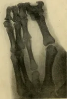 An illustration from The Roentgen rays in medicine and surgery as an aid in diagnosis and as a therapeutic agent : designed for the use of practitioners and students (1901)