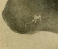 An illustration from The Roentgen rays in medicine and surgery as an aid in diagnosis and as a therapeutic agent : designed for the use of practitioners and students (1901)