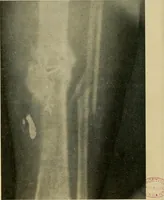 An illustration from The Roentgen rays in medicine and surgery as an aid in diagnosis and as a therapeutic agent : designed for the use of practitioners and students (1901)