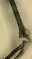 An illustration from The Roentgen rays in medicine and surgery as an aid in diagnosis and as a therapeutic agent : designed for the use of practitioners and students (1901)