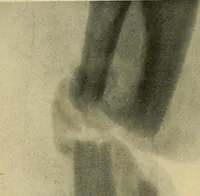 An illustration from The Roentgen rays in medicine and surgery as an aid in diagnosis and as a therapeutic agent : designed for the use of practitioners and students (1901)