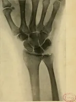 An illustration from The Roentgen rays in medicine and surgery as an aid in diagnosis and as a therapeutic agent : designed for the use of practitioners and students (1901)