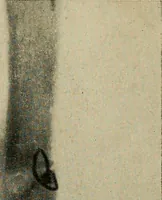 An illustration from The Roentgen rays in medicine and surgery as an aid in diagnosis and as a therapeutic agent : designed for the use of practitioners and students (1901)