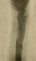 An illustration from The Roentgen rays in medicine and surgery as an aid in diagnosis and as a therapeutic agent : designed for the use of practitioners and students (1901)