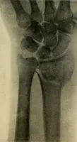 An illustration from The Roentgen rays in medicine and surgery as an aid in diagnosis and as a therapeutic agent : designed for the use of practitioners and students (1901)