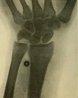 An illustration from The Roentgen rays in medicine and surgery as an aid in diagnosis and as a therapeutic agent : designed for the use of practitioners and students (1901)