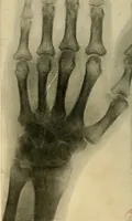 An illustration from The Roentgen rays in medicine and surgery as an aid in diagnosis and as a therapeutic agent : designed for the use of practitioners and students (1901)