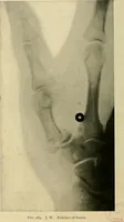 An illustration from The Roentgen rays in medicine and surgery as an aid in diagnosis and as a therapeutic agent : designed for the use of practitioners and students (1901)