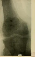 An illustration from The Roentgen rays in medicine and surgery as an aid in diagnosis and as a therapeutic agent : designed for the use of practitioners and students (1901)