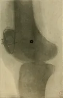 An illustration from The Roentgen rays in medicine and surgery as an aid in diagnosis and as a therapeutic agent : designed for the use of practitioners and students (1901)