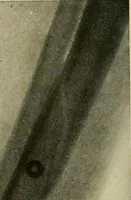 An illustration from The Roentgen rays in medicine and surgery as an aid in diagnosis and as a therapeutic agent : designed for the use of practitioners and students (1901)