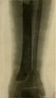 An illustration from The Roentgen rays in medicine and surgery as an aid in diagnosis and as a therapeutic agent : designed for the use of practitioners and students (1901)