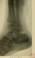 An illustration from The Roentgen rays in medicine and surgery as an aid in diagnosis and as a therapeutic agent : designed for the use of practitioners and students (1901)