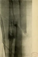 An illustration from The Roentgen rays in medicine and surgery as an aid in diagnosis and as a therapeutic agent : designed for the use of practitioners and students (1901)