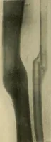 An illustration from The Roentgen rays in medicine and surgery as an aid in diagnosis and as a therapeutic agent : designed for the use of practitioners and students (1901)
