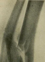 An illustration from The Roentgen rays in medicine and surgery as an aid in diagnosis and as a therapeutic agent : designed for the use of practitioners and students (1901)