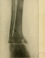 An illustration from The Roentgen rays in medicine and surgery as an aid in diagnosis and as a therapeutic agent : designed for the use of practitioners and students (1901)