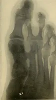 An illustration from The Roentgen rays in medicine and surgery as an aid in diagnosis and as a therapeutic agent : designed for the use of practitioners and students (1901)