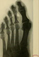 An illustration from The Roentgen rays in medicine and surgery as an aid in diagnosis and as a therapeutic agent : designed for the use of practitioners and students (1901)