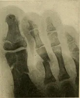 An illustration from The Roentgen rays in medicine and surgery as an aid in diagnosis and as a therapeutic agent : designed for the use of practitioners and students (1901)