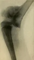 An illustration from The Roentgen rays in medicine and surgery as an aid in diagnosis and as a therapeutic agent : designed for the use of practitioners and students (1901)