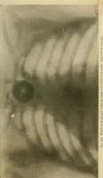 An illustration from The Roentgen rays in medicine and surgery as an aid in diagnosis and as a therapeutic agent : designed for the use of practitioners and students (1901)